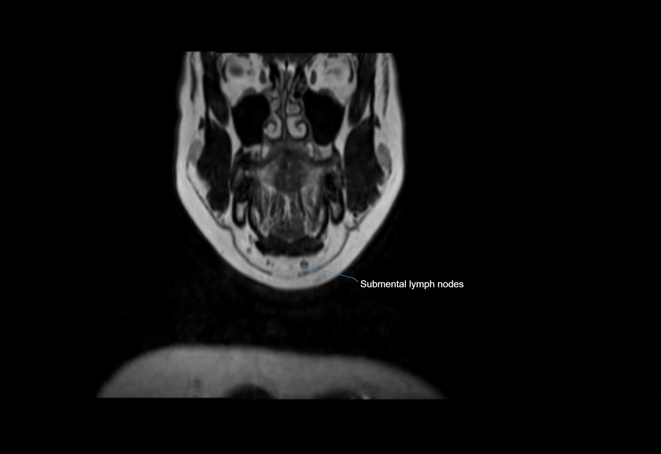 Neck coronal lymph node cross sectional MRI anatomy 3T MRI  image-img-00001-00059.webp